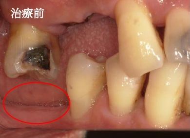 インプラント治療前写真