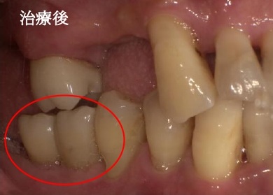 インプラント治療後写真