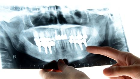 歯周再⽣療法